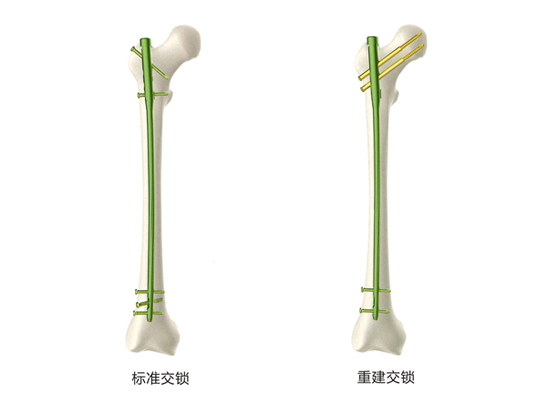ProTek股骨髓内钉