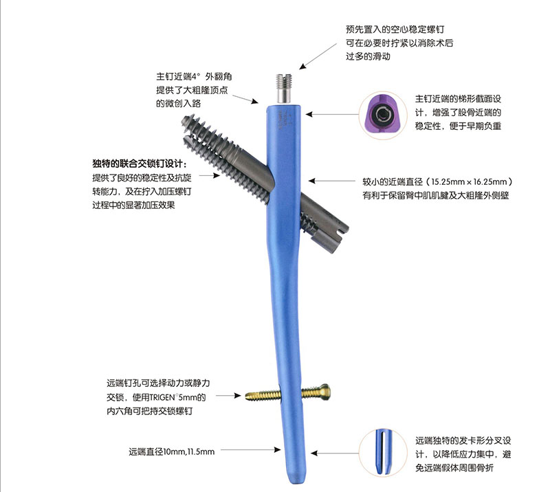 股骨近端联合加压髓内钉